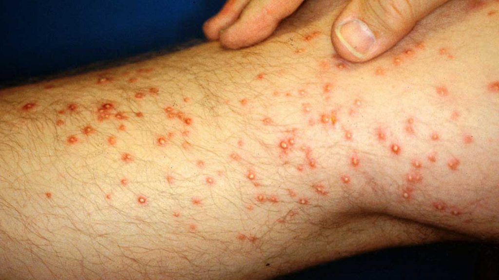 Vasculitis tratamiento natural